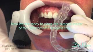 Starting Invisalign Treatment Placing Attachments and Fitting Tray 1 [upl. by Cheria]