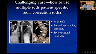 Adult Scoliosis and Spinal Deformity Surgery Update  UCSF Community Grand Rounds [upl. by Atisusej]