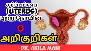 uterus cancer symptoms in tamil uterine cancer in tamil Dr Akilamani கர்ப்பப்பை புற்றுநோய் [upl. by Lindsley654]