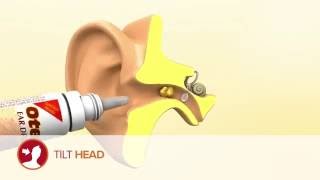 How to use Otex Ear Drops [upl. by Naghem]