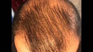 14 month’s using minoxidil  Rogaine 5 Before amp After results [upl. by Alig715]