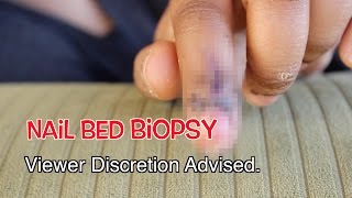 Nail Bed Biopsy Experience  Melonoma  Cancer [upl. by Brose999]