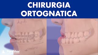 Chirurgia ORTOGNATICA  Operazione MANDIBOLA per correggere la sua posizione © [upl. by Town]