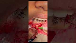 Surgery for impacted mandibular canine traction [upl. by Yelsew]