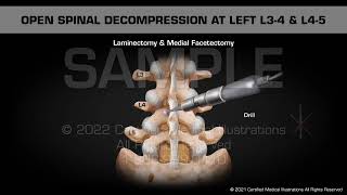 Open Spinal Decompression at Left L34 amp L45 [upl. by Romelda127]