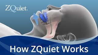 Want to Stop Snoring Learn How ZQuiet Anti Snoring Mouthpieces Work [upl. by Acenes]