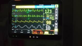 Ventricular Bigeminy [upl. by Sheya]