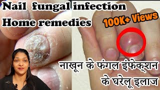 Paronychia Treatment Home Remedies In Hindi finger infection home remedy \nail fungus treatment [upl. by Hestia996]