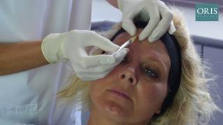 Frontalis Treatments with Botox [upl. by Haff]