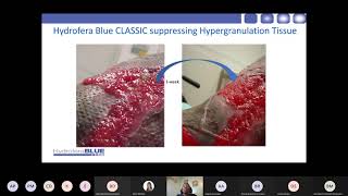 Video Recording of Hydrofera Blue Product Inservice [upl. by Gnourt834]