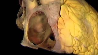 Aclands Video Atlas of Human Anatomy Right Atrium [upl. by Ettedualc]