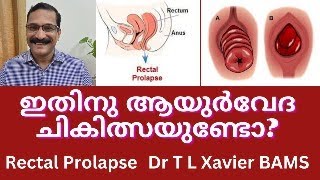 മലാശയം തള്ളി വരുന്നു  Rectal Prolapse Symptoms amp Ayurveda [upl. by Ecirb]