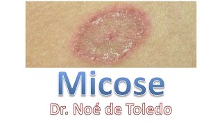 Micose  Dr Noé de Toledo [upl. by Nivi]