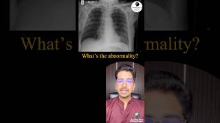 What’s the abnormality in Xray pulmonology radiology icu [upl. by Royo]