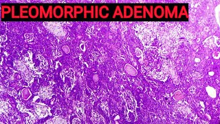 Benign Mixed Tumour of Salivary Gland  Pleomorphic Adenoma Histopathology [upl. by Ahsilam]