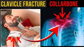 clavicle fracture  collarbone fracture  clavicle fracture natural healing [upl. by Butterworth]