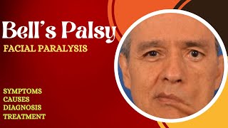 Bell’s palsy  Facial Paralysis  Facial Nerve Paralysis  Facial Nerve Palsy [upl. by Devehcoy]