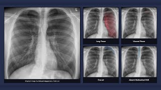 Simple Pneumothorax Explanation of Chest Xray Findings [upl. by Haroldson]