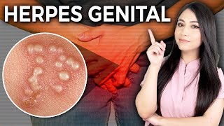 ¿Por qué el HERPES no tiene cura l Herpes genital Causa síntomas y TRATAMIENTO👩🏻‍⚕️ drapauzuniga [upl. by Alleunamme]