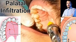 Local Anesthesia Palatal Infiltration Technique Maxillary Anesthesia Techniques dentistry [upl. by Ainnek123]