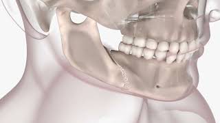 Orthognathic Surgery 3D Animation [upl. by Narih]