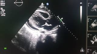 effuso constrictive pericarditis echocardiography [upl. by Pokorny]