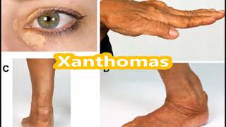 Xanthoma skill lab [upl. by Roxana]