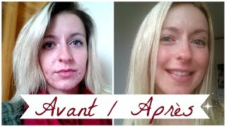 ACNE ❀ Roacutane mois après mois [upl. by Eelytsirk]