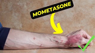 Mometasone The Ultimate Solution for Allergies and Skin Conditions [upl. by Ciryl]