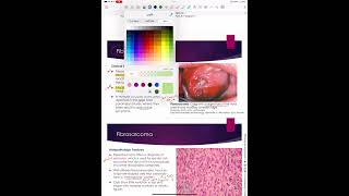 Fibrosarcoma [upl. by Blatman]