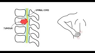 Spinal Cord Compression [upl. by Eelarol131]