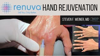 Renuva Hand RejuvenationVolumization  Dr Steven F Weiner [upl. by Fatma518]