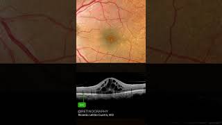 Cystoid macular edema [upl. by Riatsala]