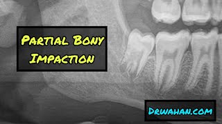 Black  White Version Mesioangular Impaction Removed with a Buccal Trough [upl. by Annekcm]