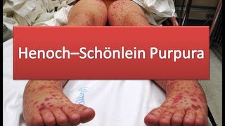 HenochSchönlein Purpura [upl. by Filler]