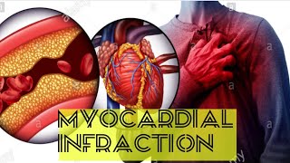 Myocardial infarction explained symptoms assessment Diagnosis and treatment [upl. by Celene]