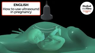 How to use ultrasound in pregnancy [upl. by Ymmit253]