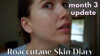 Roaccutane Daily Skin Diary  Month 3  ft Temu Haul [upl. by Aja293]