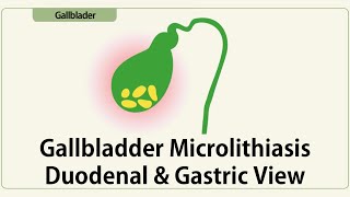 Gallbladder Microlithiasis Duodenal amp Gastric View [upl. by Georgeta]