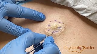 Removal of an epidermal cyst on the back [upl. by Svend]