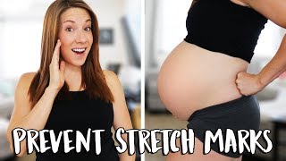 How To Prevent Stretch Marks [upl. by Turro]