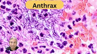 Anthrax enterocolitis [upl. by Diraf]