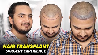 Hair Transplant in Muzaffarnagar  Best Results amp Cost of Hair Transplant in Muzaffarnagar [upl. by Brodsky130]