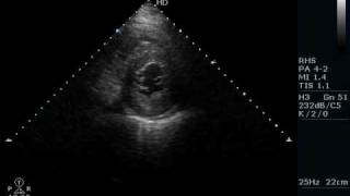 Regional wall motion abnormalities [upl. by Abramson]