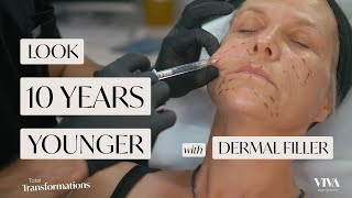 Look 10 Years Younger With Dermal Filler  Before amp After  Total Transformations Ep 5 [upl. by Harper]