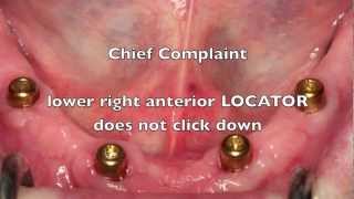 NEW Locator Dental Implant Attachments  Workshop Tips [upl. by Flodnar114]