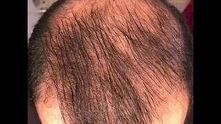 8 months using minoxidil  Rogaine 5 Before amp After results [upl. by Annelg]