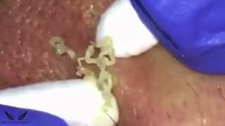 Blackhead Removal  Cystic Acne Treatment  Elderly Pimple Popping  Hidden Acne Spa Relaxing  111 [upl. by Tali116]