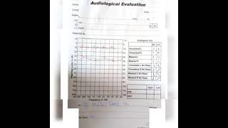 Audiological Evaluation Audiogram conductivemixed SNHL hearing Losstypes of Hearing Loss। [upl. by Zelikow]