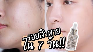 รอยสิวจงหมดไป รีวิว Kiehl’s Dark Spot Serum ตัวดัง พิสูจน์ 7 วัน รอยสิวหายจริงไหม  Soundtiss [upl. by Ravo]